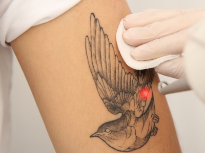 Pigmentation_Tattoo